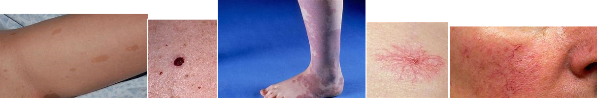 Removal of Vascular Lesions